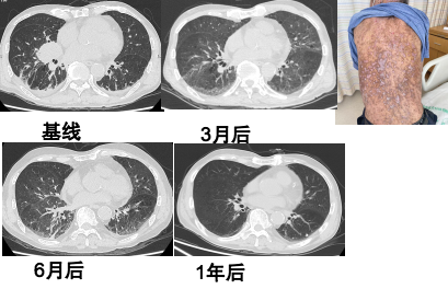 免疫治疗后发皮疹？华山医院肺癌及免疫治疗相关不良反应多学科团队