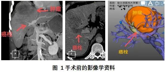 哈医大一院肝脏微创外科成功实施完全腹腔镜下门静脉切开取癌栓+