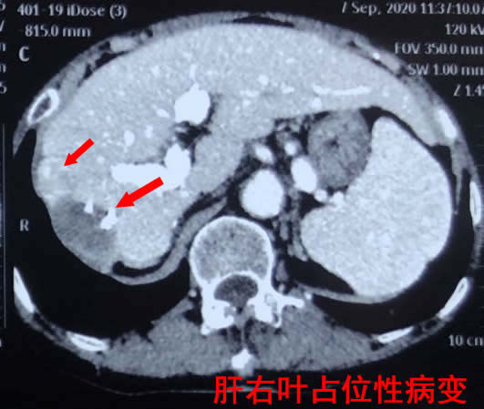 哈医大一院多学科协作应用荧光腹腔镜技术为70岁肝癌复发患者解剖