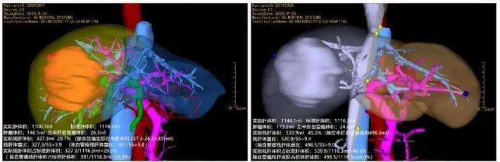 山东首例！齐鲁医院肝胆外科张宗利、郭森团队成功开展全腹腔镜联合